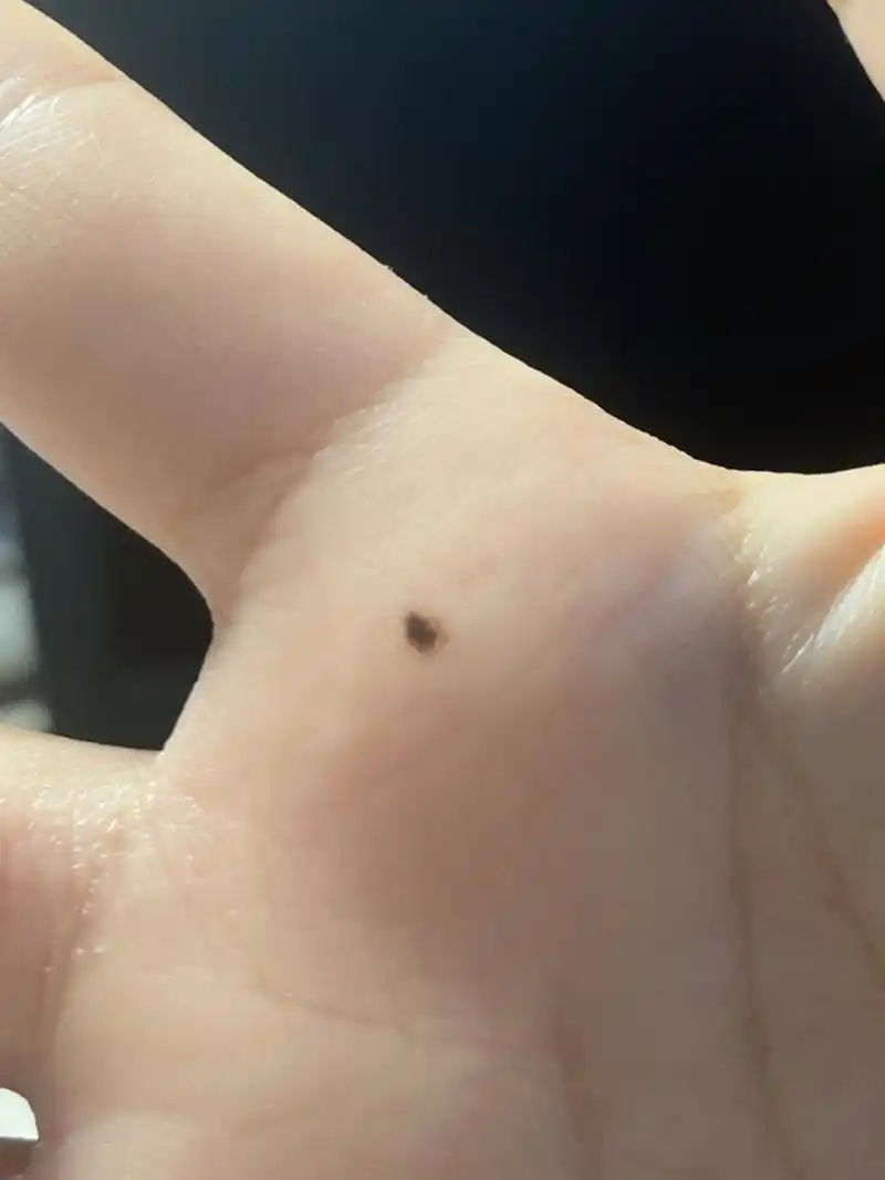 手掌上突然长了一颗痣 友友们,我手上这个地方原来是没有痣的,但是在