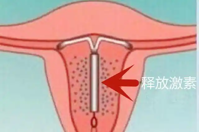 女人在生完孩子后,选择结扎好还是上环好?不同选择,影响很大