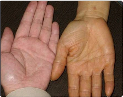 手心发黄的原因