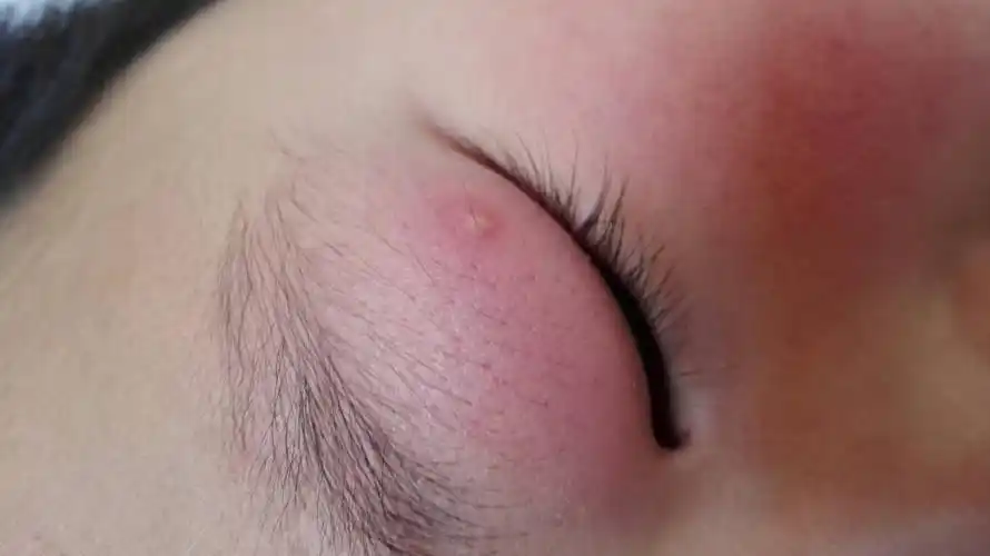 孩子九岁,前几天眼睛上长了个小白疙瘩…请问,这是怎么回事儿啊?