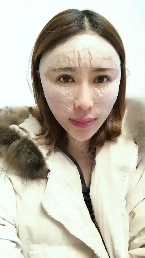 【长沙科颜美自体脂肪全脸填充术后第1天】