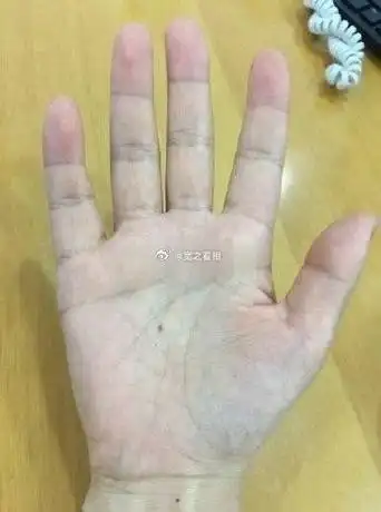 你的掌心有痣,主自身钱财运较好.