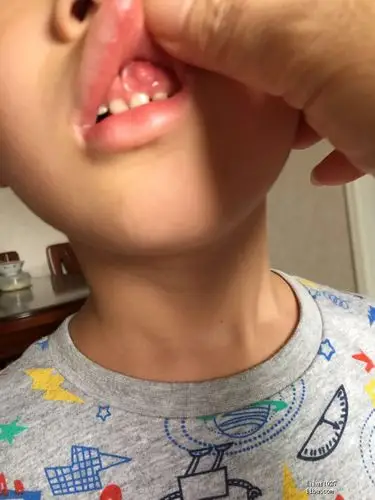 请帮忙看看孩子牙龈上长的是什么