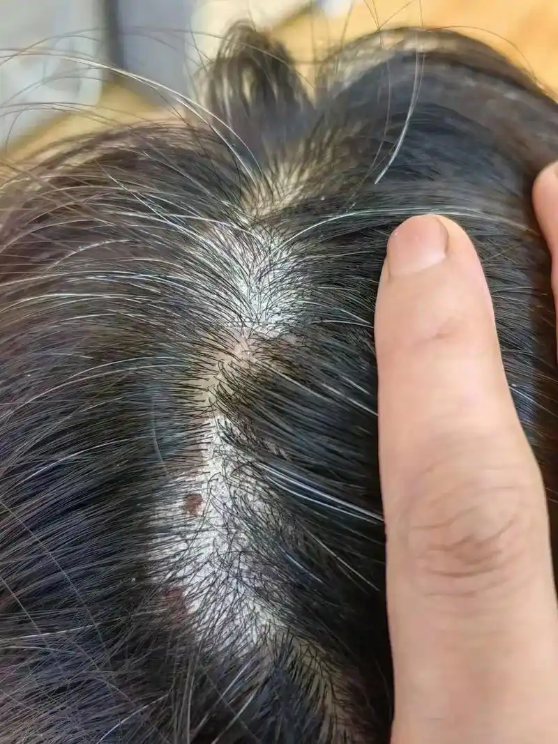 75千万不要小看头屑,头痒,头皮存在的一种皮屑芽 - 抖音