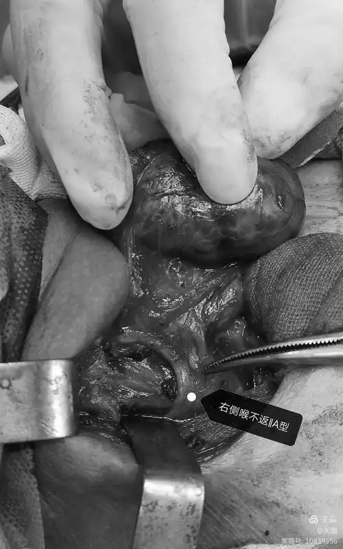 这是我们遇到的‖b型喉不返神经.什么情况下应警惕存在喉不返神经?