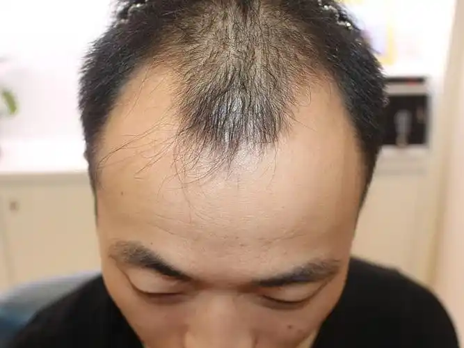 我是标准的m型脱发!