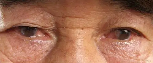 【分享】一例双侧翼状胬肉