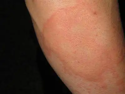 热性荨麻疹偏方