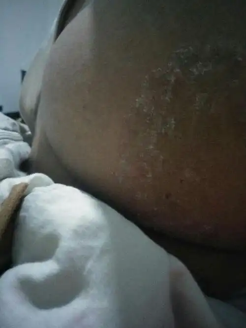 为什么我屁股上面长出这种东西痒痒