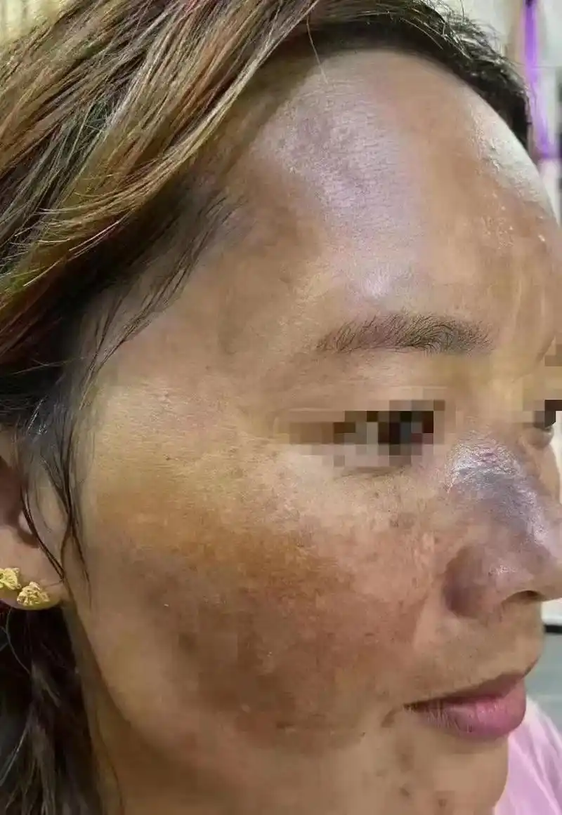 曲净专做别人做不了的斑专做别人做坏的斑问题性皮肤的终点站