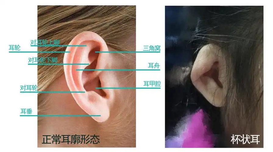 有4个主要特征:耳廓卷曲(轻者耳轮自身折叠,重者整个耳廓上部垂盖住耳