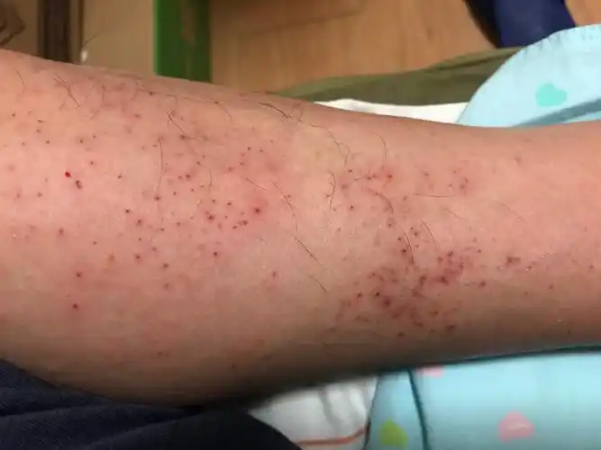 入冬前小腿很痒抓挠出血后出现红疙瘩怎么回事