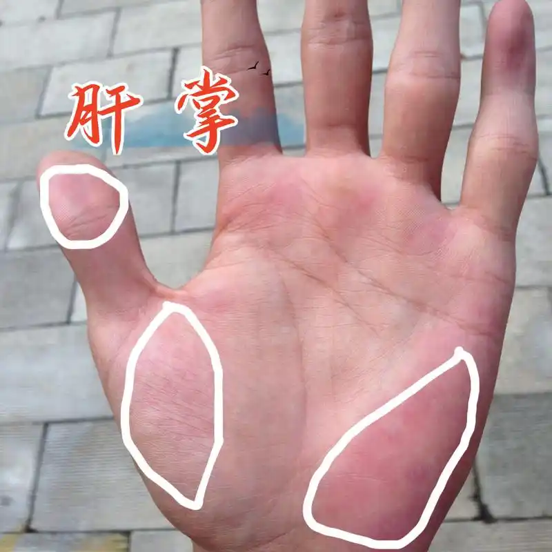 肝掌也称为"掌红".