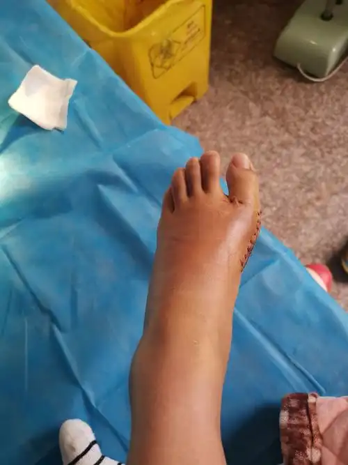 我的拇外翻手术过程术后两周