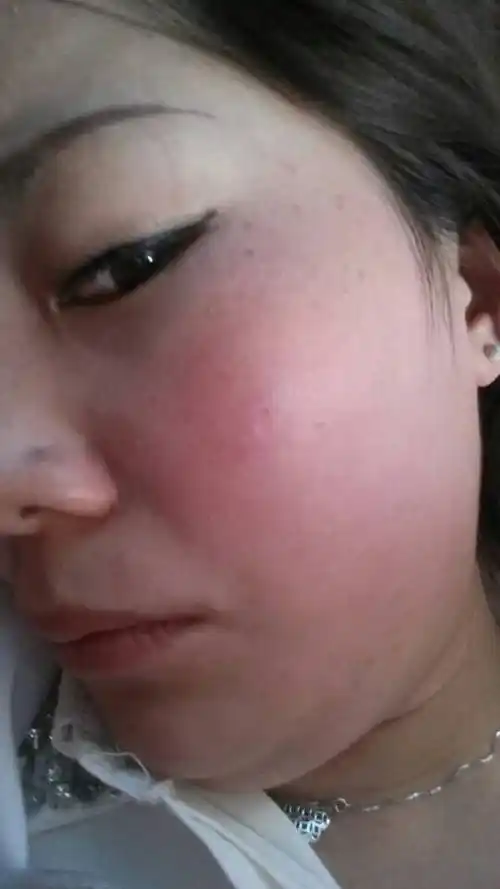 脸肿的治疗预防