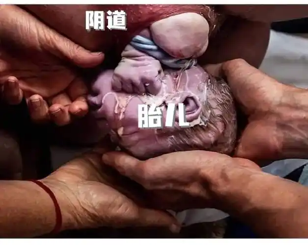 顺产阴道撕裂的四个等级##十顺九裂