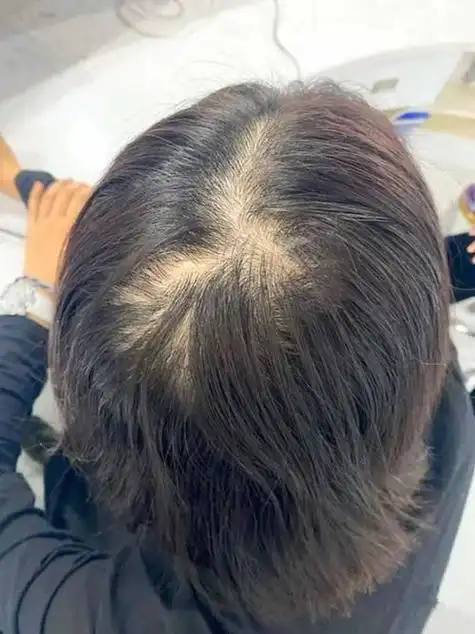 脱发太严重怎么办啊,脱发太严重怎么处理