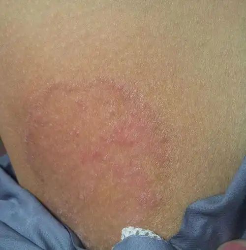 很痒,抓的话会有些白色的碎屑(感觉想死皮的样子),请教下这是股癣吗