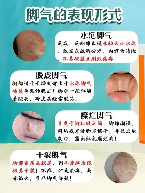 不同位置的脚气症状266166天祛除脚气秘籍 78我是水泡加糜烂