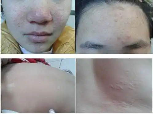 结节性硬化症能治好吗结节性硬化中医治疗