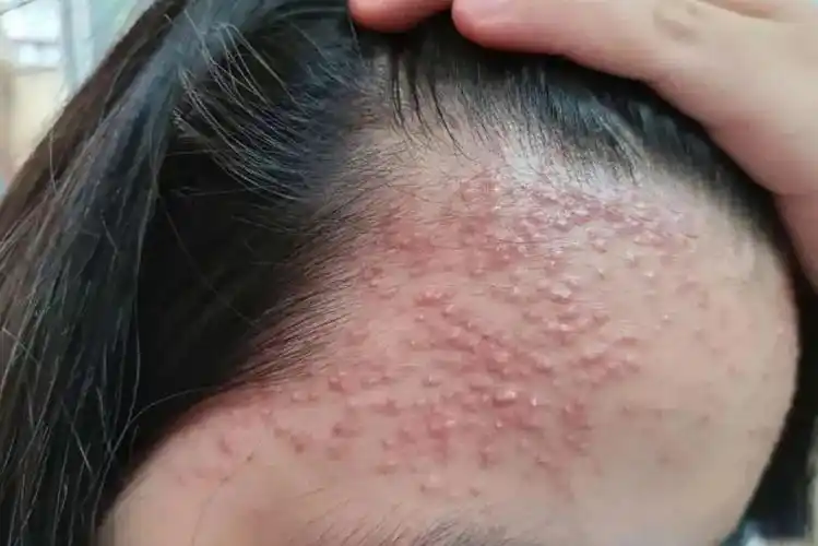 女性毛囊炎的症状和图片