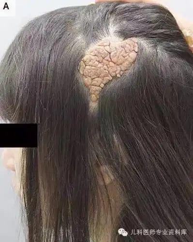 在青春期时,受到雄性激素的刺激,皮脂腺痣会扩大,呈疣状.