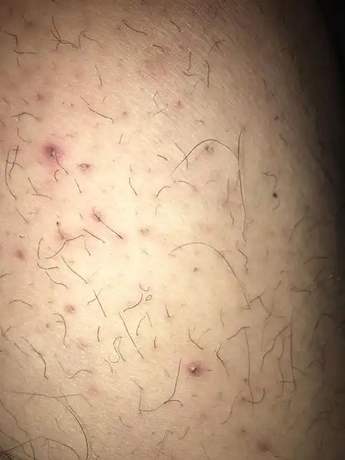 大腿上每过几个月,大腿上就会长个疙瘩又刺疼,又