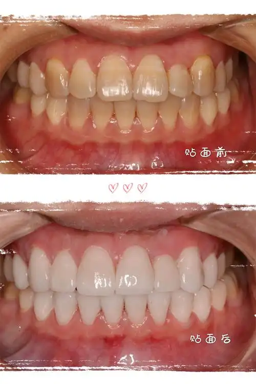 牙贴面要把牙齿磨小吗?要磨多厚的牙齿呢?