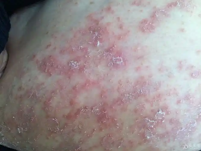 银屑病求治疗方案