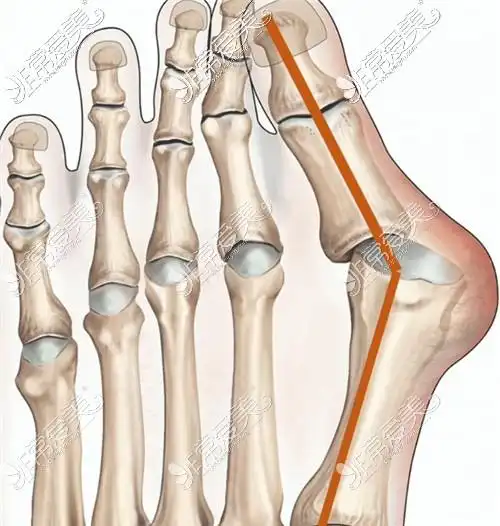 做了大脚骨手术一年又复发了手术失败原因竟然是这个