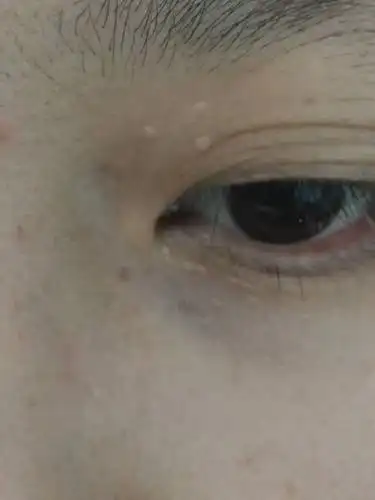 这个是脂肪粒吗?上眼皮下眼皮都有,好几年了,感觉慢慢在增多,两个