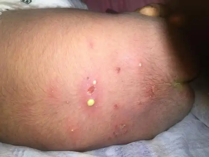 新生儿皮肤处泡了