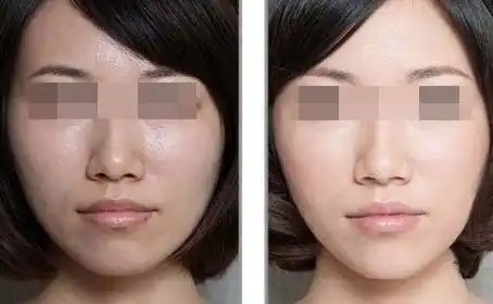 呼市做光子嫩肤安全不?