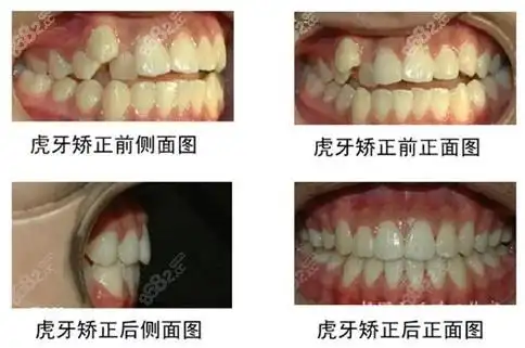 虎牙矫正前后对比案例