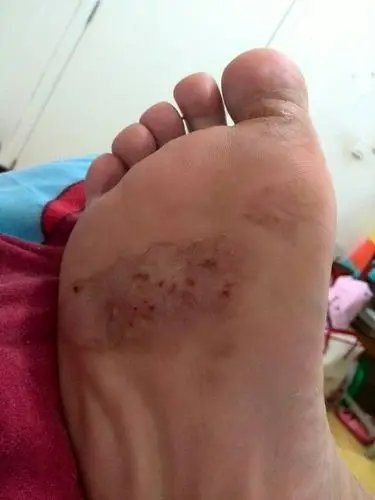 脚底肿得不敢睡觉,神经痛