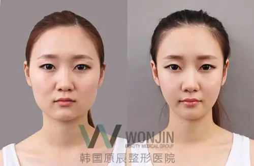 韩国原辰医院额头填充日记对比