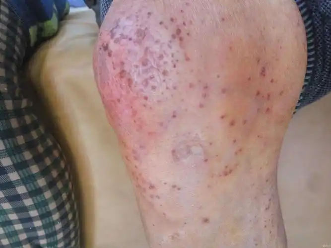 今天的病人,皮疹不痛不痒 - 皮肤及性传播疾病讨论版 - 爱爱医医学