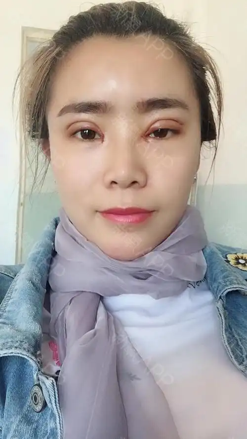 埋线双眼皮