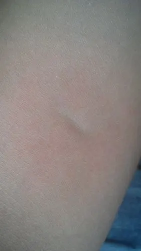 我胳膊上有一条血管是横着的是怎么了