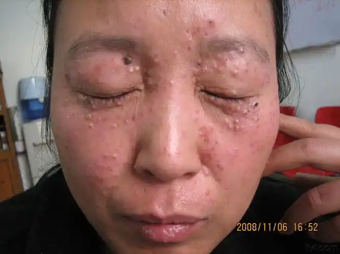 颜面播散性粟粒性狼疮1例