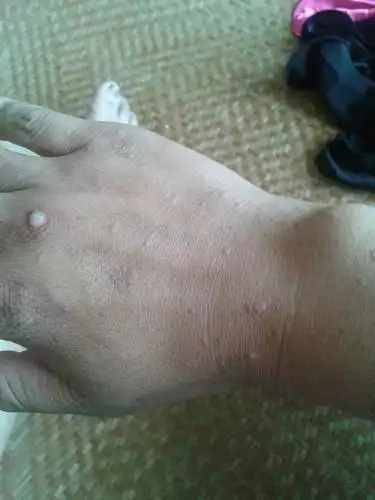 手背长了很多扁平疣,请问有什么方法冶好?