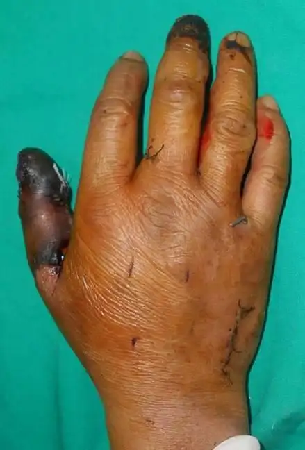 拇指脱套伤术后指体坏死再造