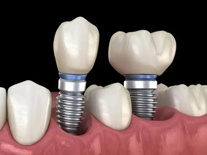 佳美口腔种植牙技术优势突出!瑞尔齿科品牌选择较多!-宜牙网