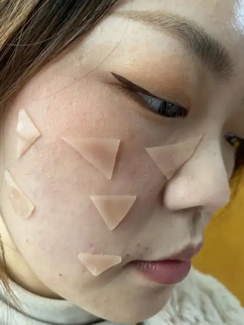 一不小心发现去痘印的好方法啊啊啊