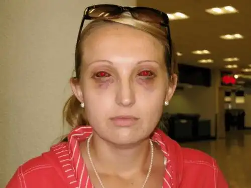 专家解答隐形眼镜和近视眼手术对潜水的影响