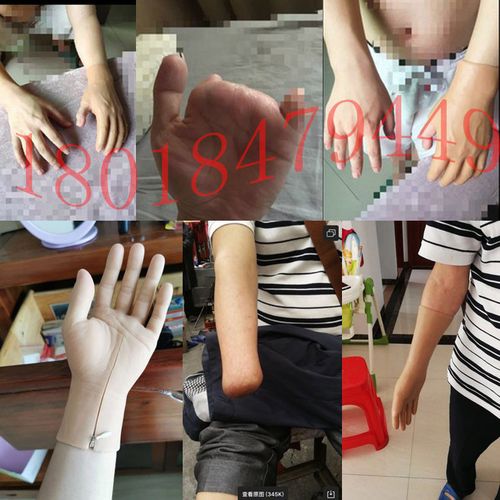 硅胶假手指套残疾人假手肢仿真定制手皮手臂义肢机械手指肌电手套