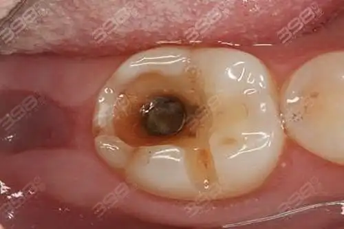 看蛀牙烂到牙神经图片了解牙齿烂洞长期不补会怎样