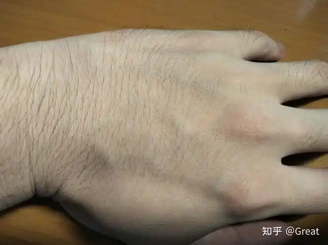 米诺地尔用后手上汗毛猛增