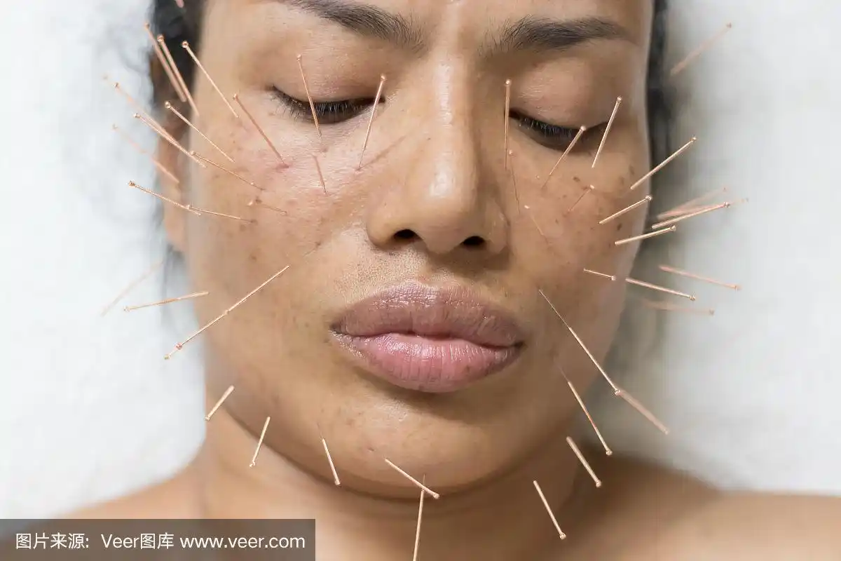亚洲女性40岁时针灸脸部保持健康,皮肤保持健康,紧致肌肤.