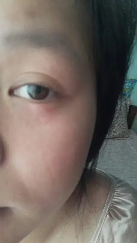 为什么眼睛下面会长这种类似蚊子咬的小包,是什么过敏?